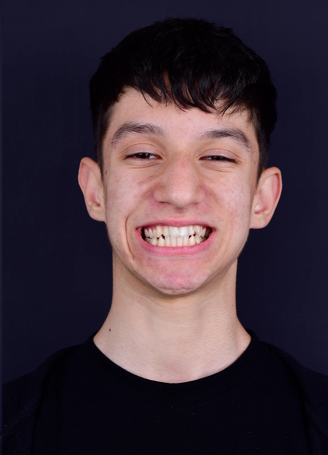 Portret pacient adolescent diagnostic ortodontic initial inghesuire dentara severa Orto Clinic Tas Razvan