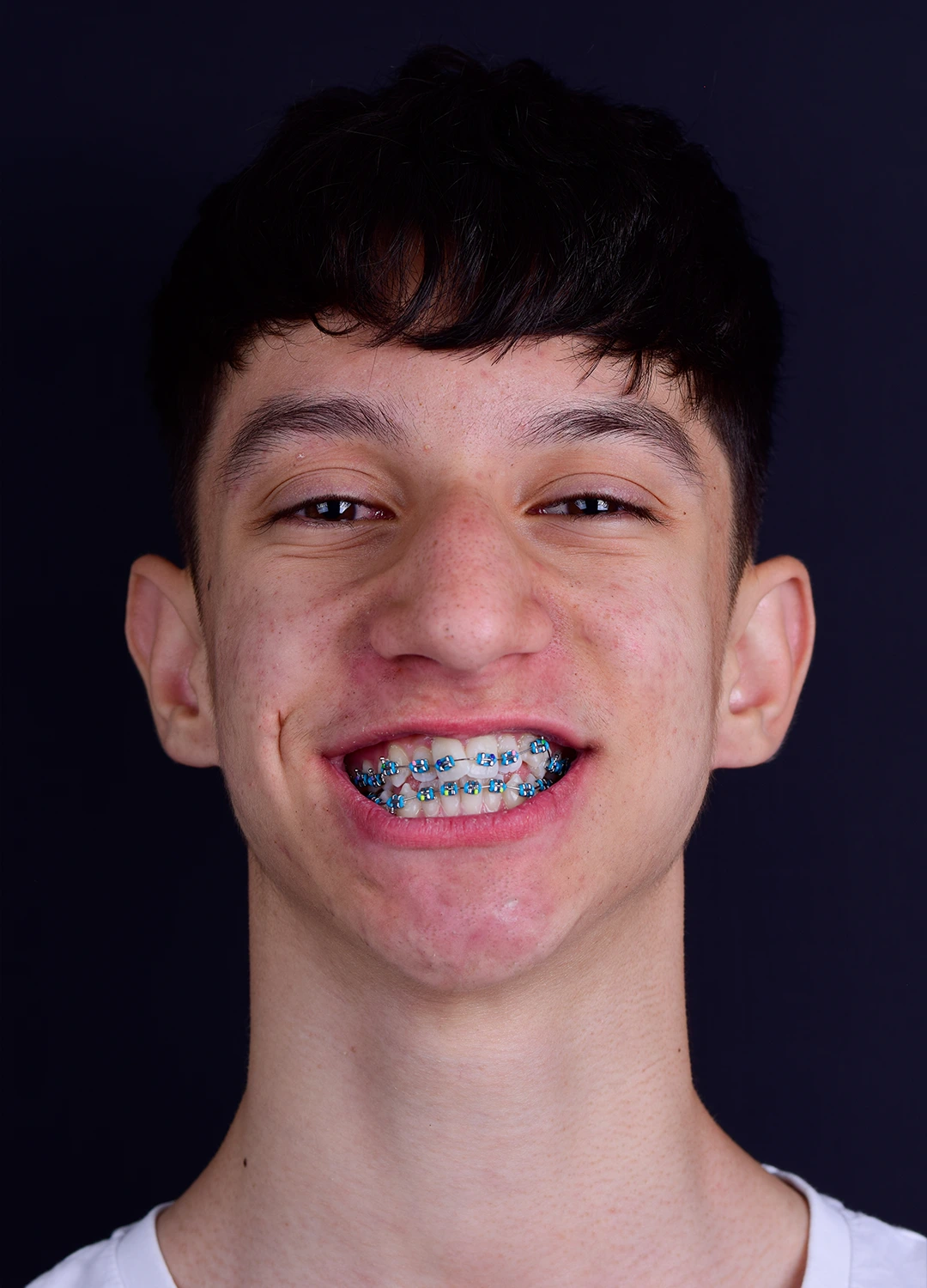 Portret pacient adolescent cu aparat dentar fix metalic si elastice colorate in timpul tratamentului la Orto Clinic Tas Razvan