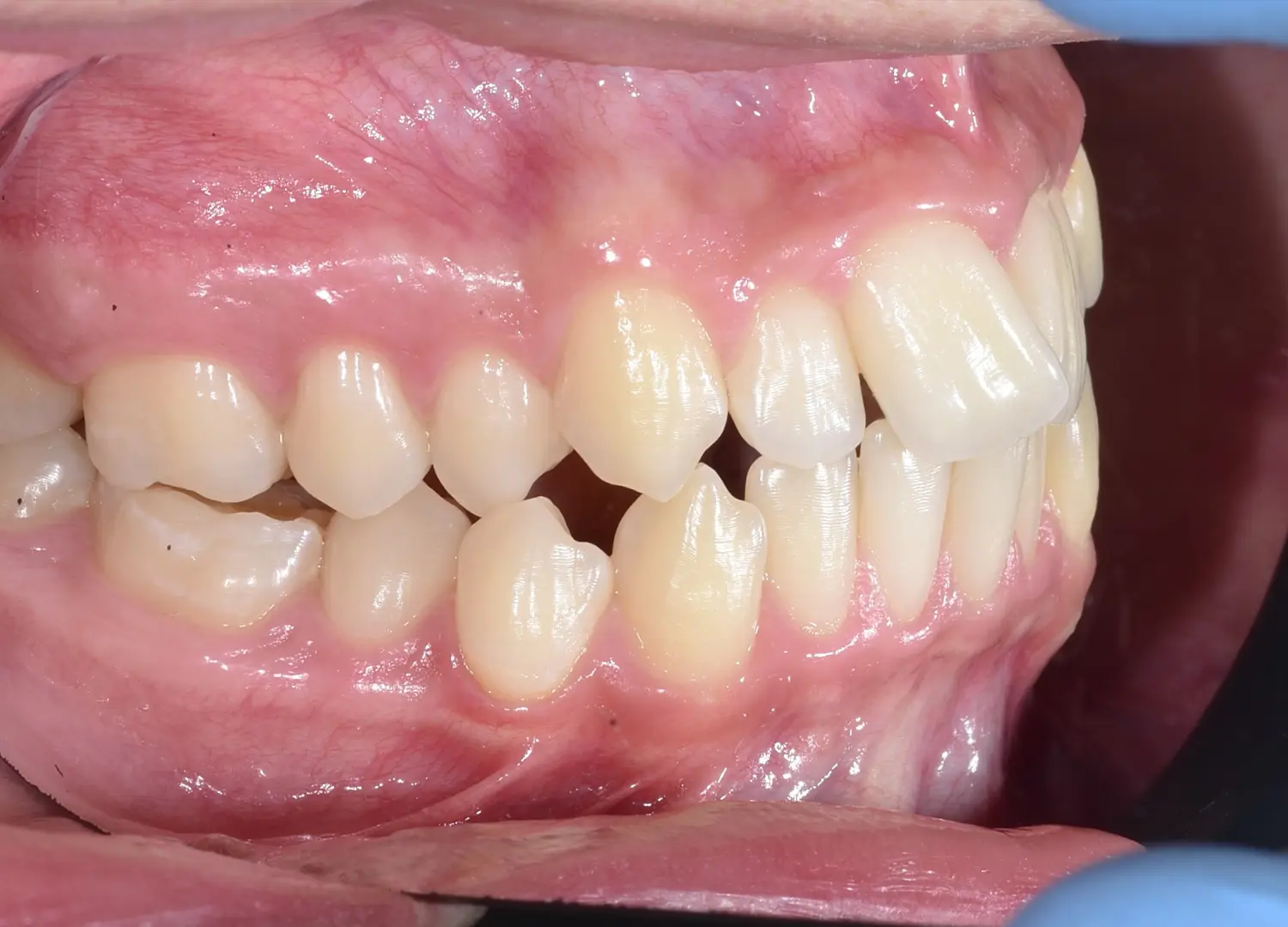 Vedere laterală diagnostic malocluzie și proeminență dentară înainte de aparat dentar.