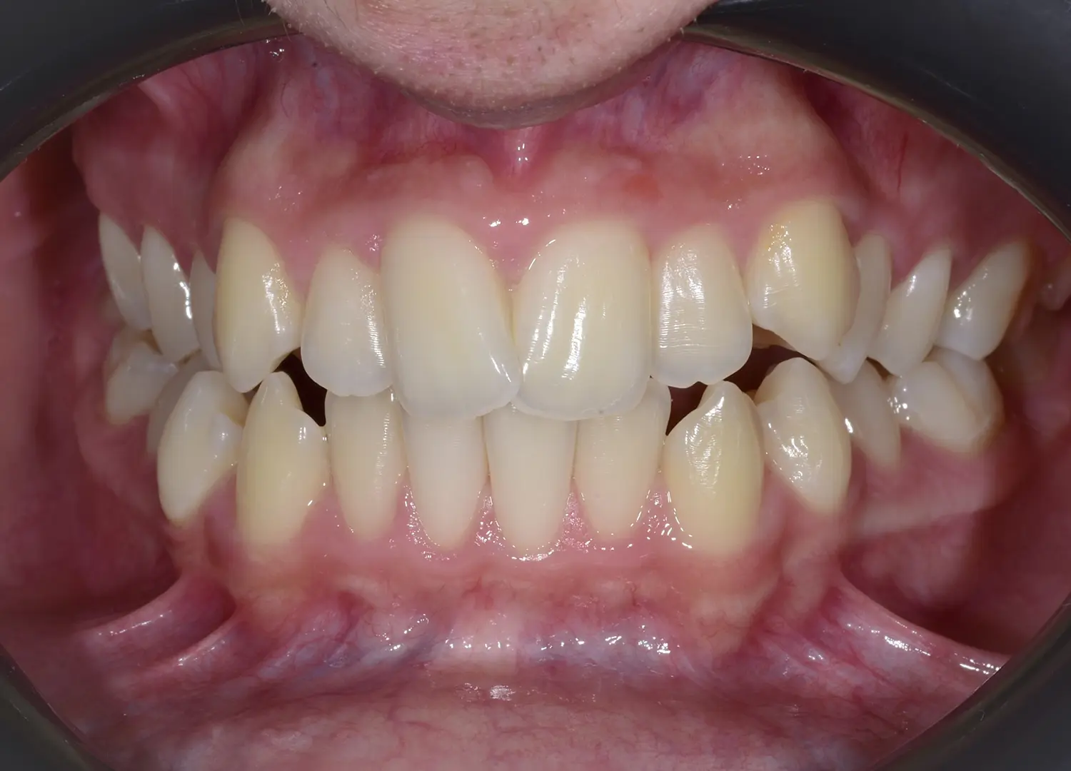 "Diagnostic ortodontic initial vedere frontala ocluzie si aliniere dentara arcade Orto Clinic Tas Razvan