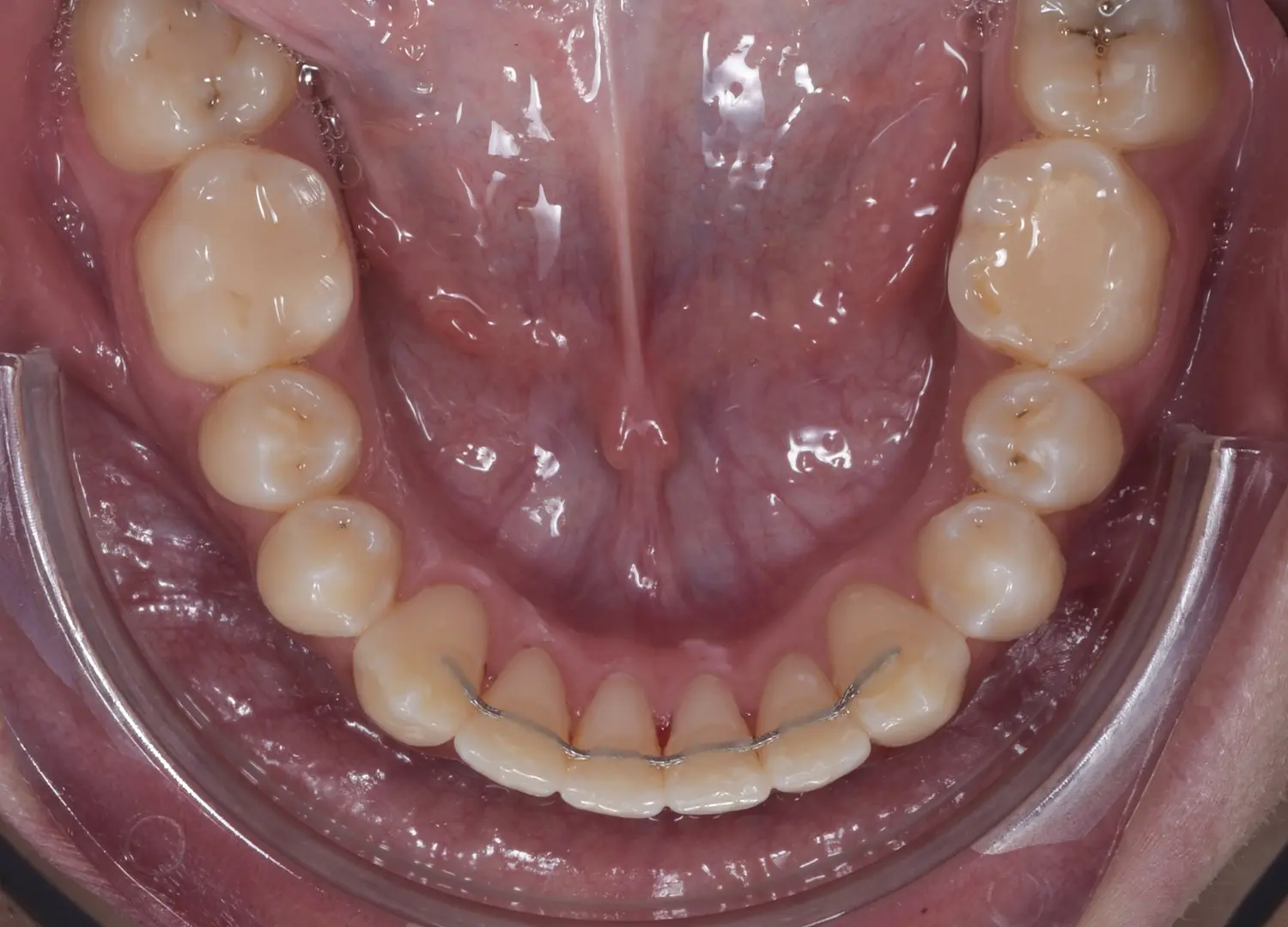 Vedere ocluzala arcada inferioara cu retainer fix din sarma colata pentru stabilitatea dintilor Orto Clinic Tas Razvan