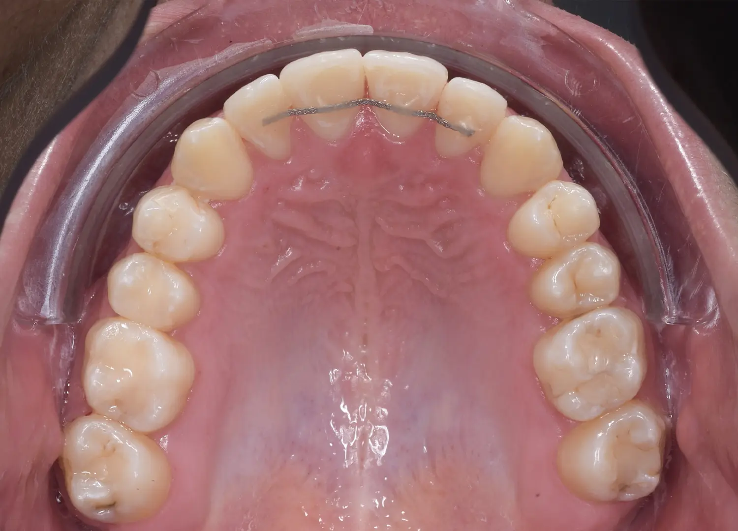 Vedere ocluzala arcada superioara cu sistem de retentie fixa din sarma colata post-tratament ortodontic Orto Clinic Tas Razvan