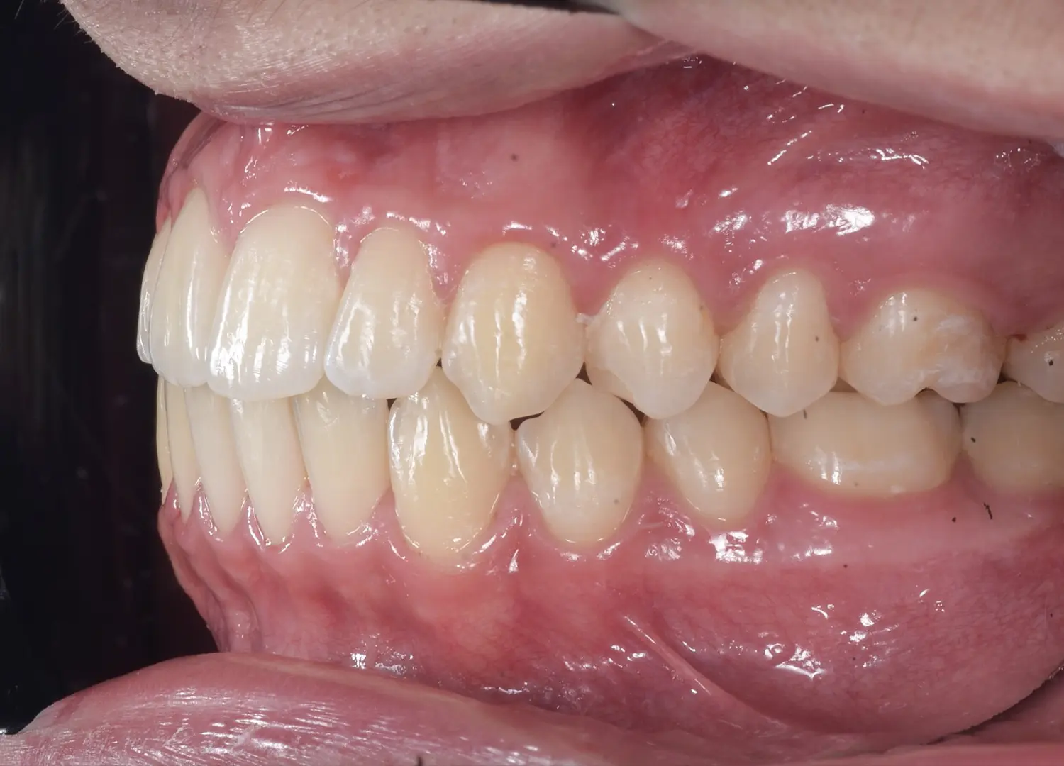 Rezultat final tratament ortodontic vedere laterala stanga ocluzie si aliniere arcade Orto Clinic Tas Razvan