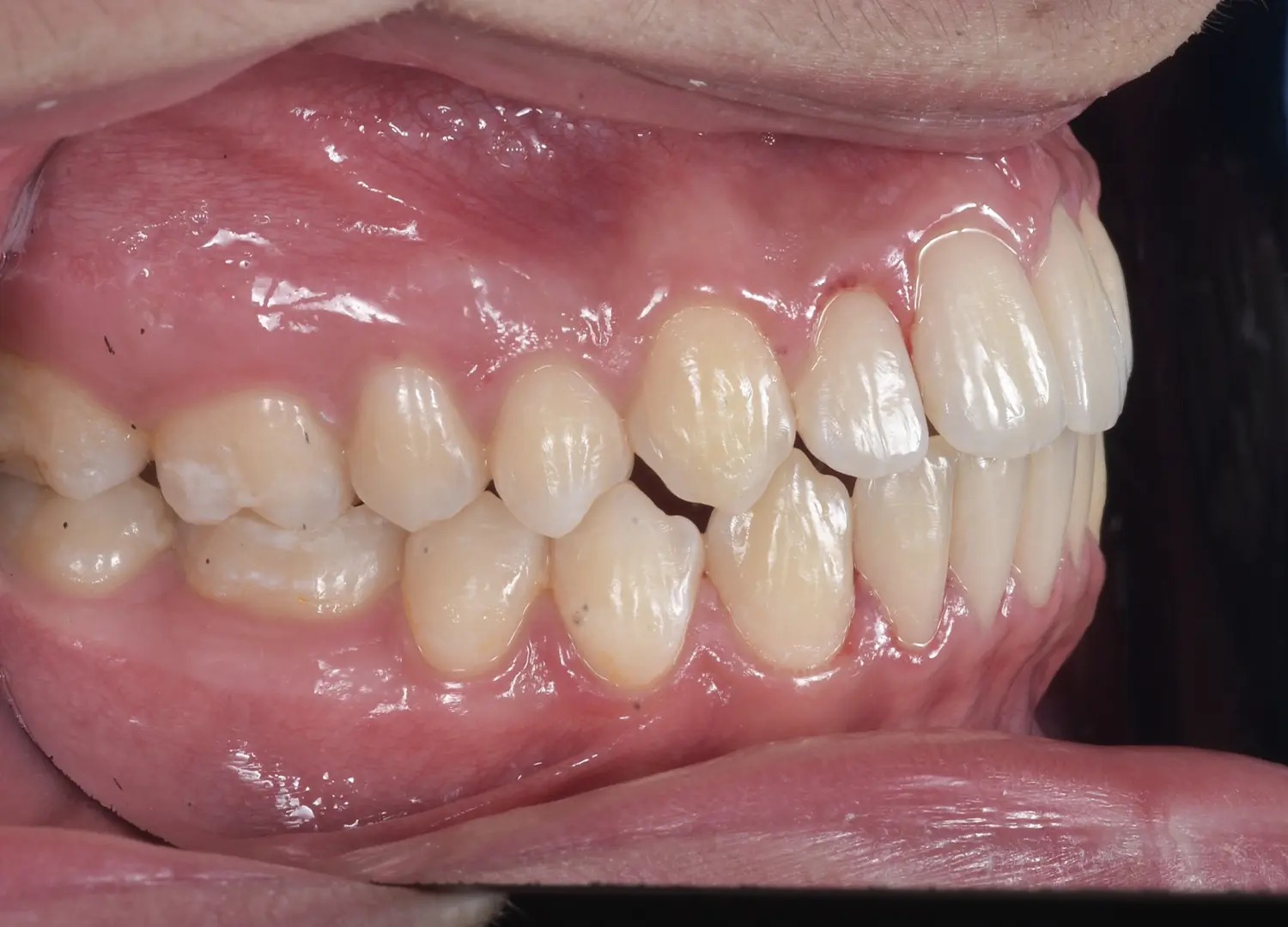 Rezultat final tratament ortodontic vedere laterala dreapta ocluzie corecta si dinti aliniati Orto Clinic Tas Razvan