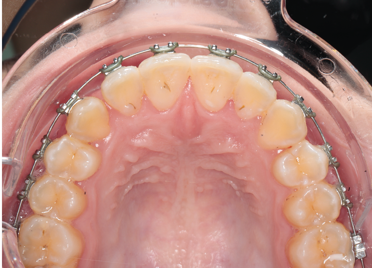 Vedere ocluzala arcada superioara cu aparat dentar fix - aliniere in curs Orto Clinic Tas Razvan