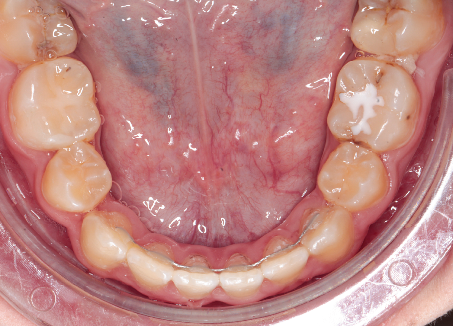 Retainer fix colat mandibula arcada inferioara post aparat dentar Orto Clinic Tas Razvan