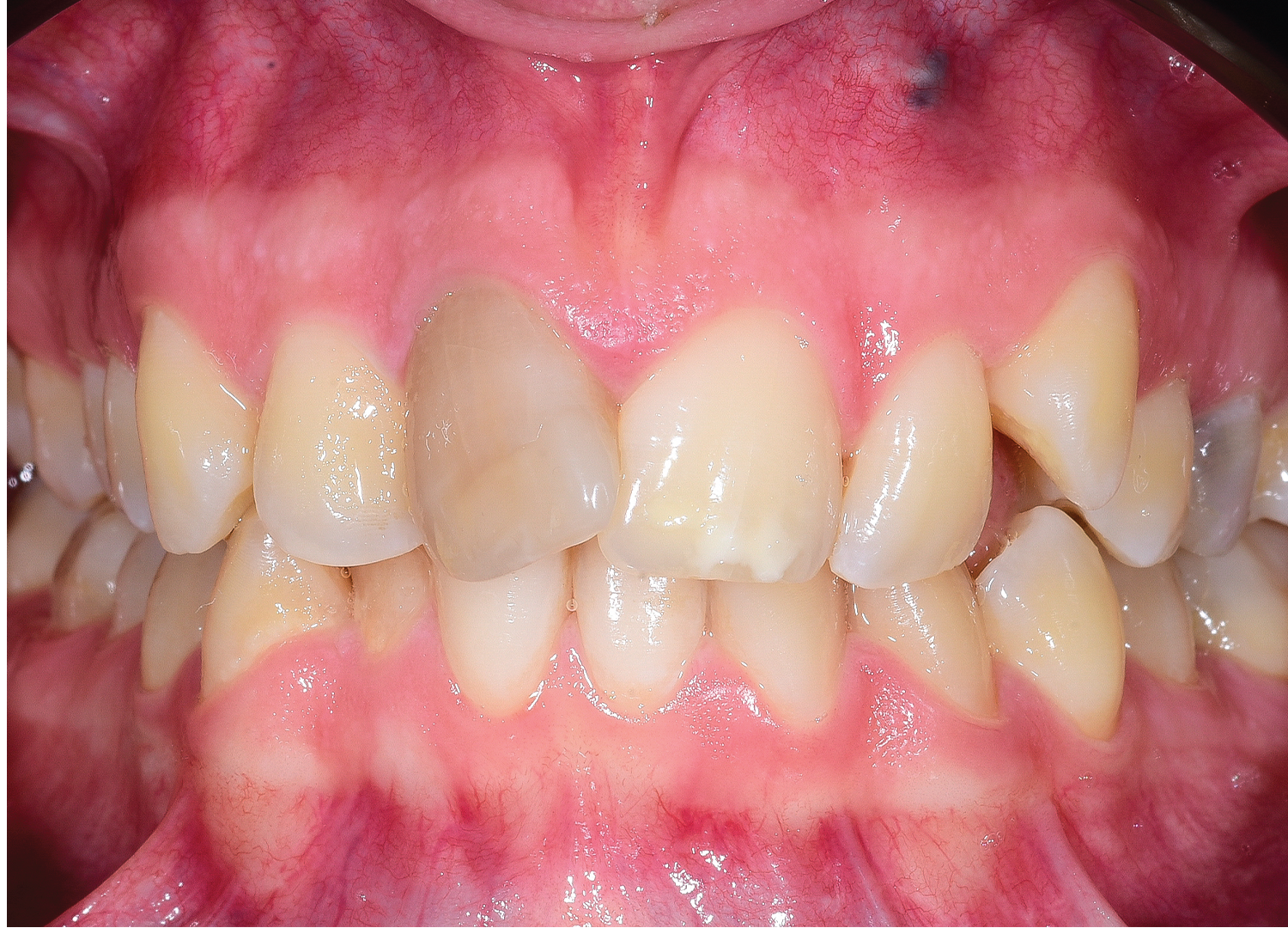 Diagnostic initial frontal inghesuire dentara si discromie severa incisiv central devital inainte de tratament Orto Clinic Tas Razvan