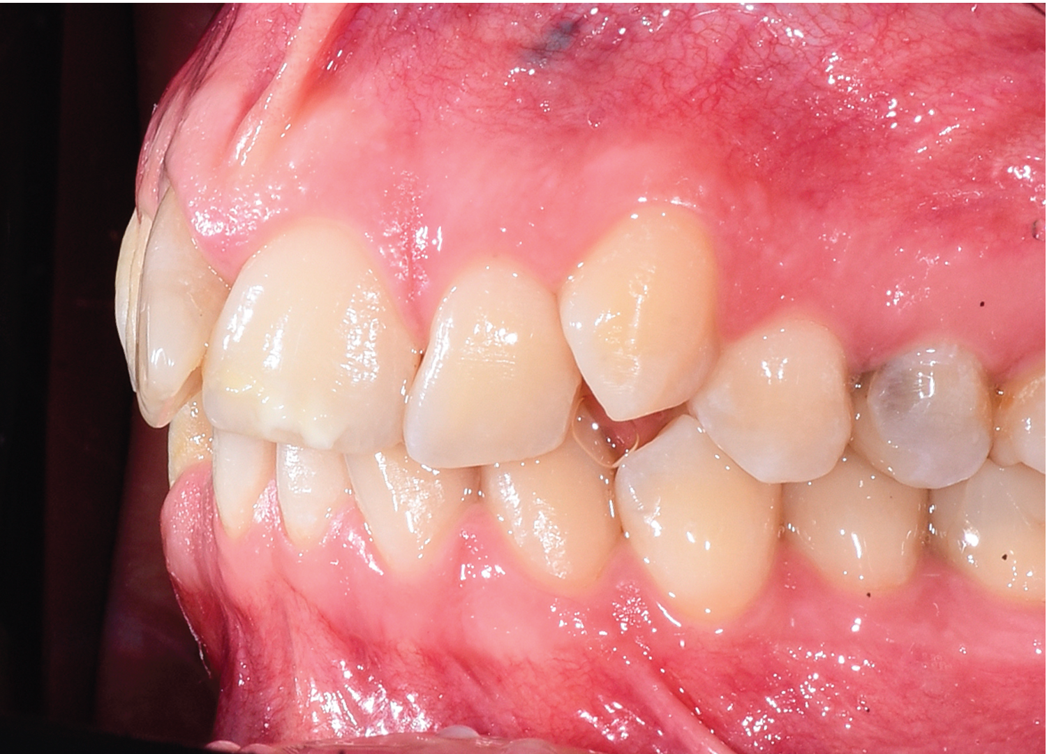 Vedere laterala stanga ocluzie dentara si aliniere arcade inainte de finisare tratament Orto Clinic Tas Razvan”