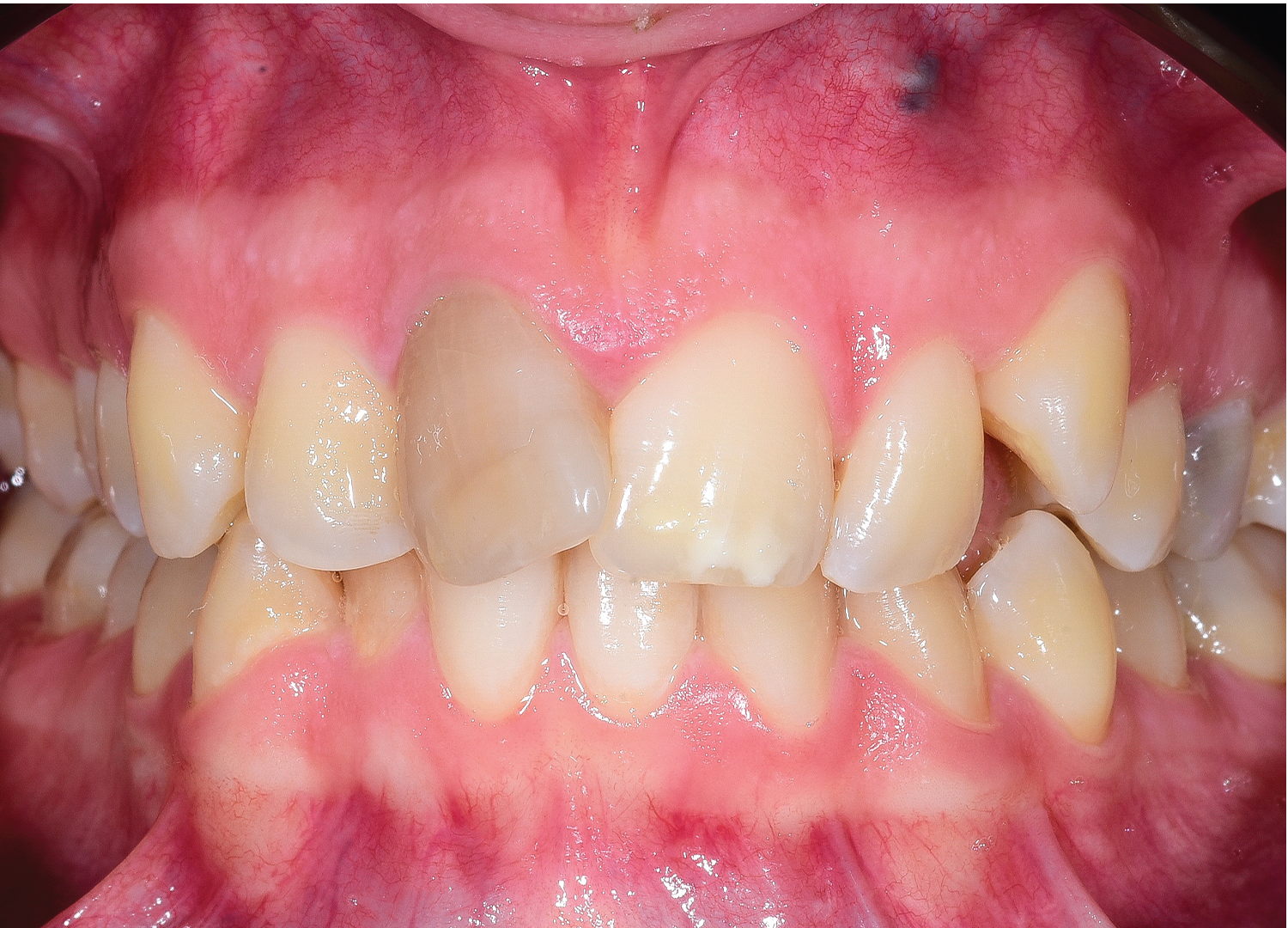 Aliniere dentara finalizata cu aparat dentar si evaluare dinte devital inainte de albire interna Orto Clinic Tas Razvan