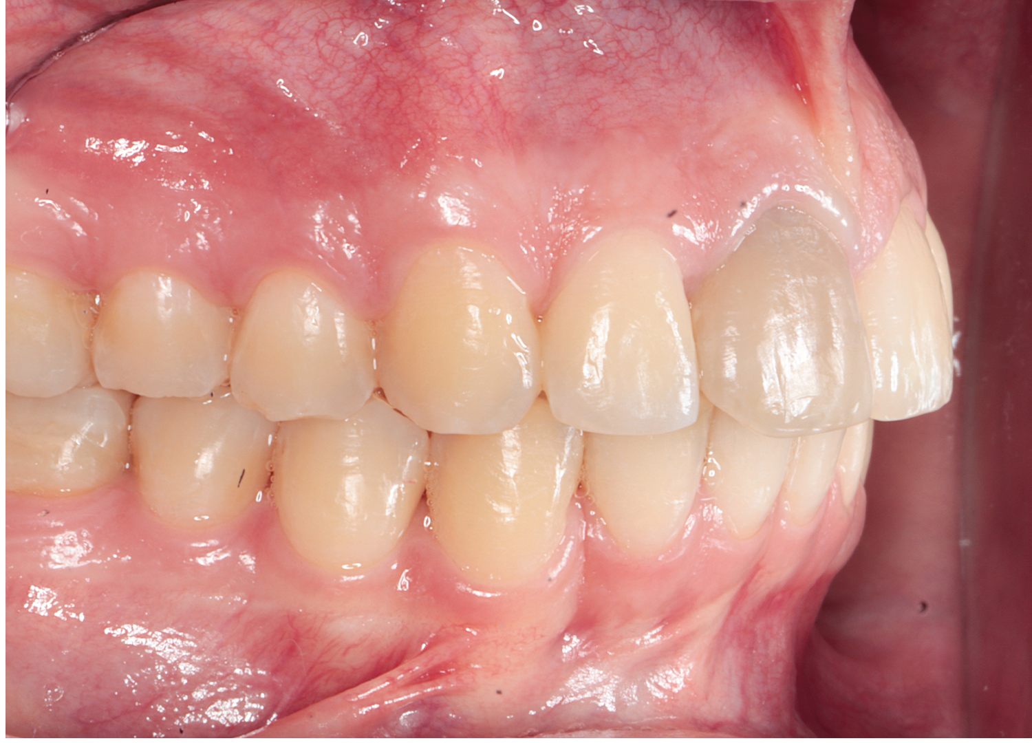 Vedere laterala diagnostic initial ocluzie dentara cu inghesuire si discromie dentara Orto Clinic Tas Razvan