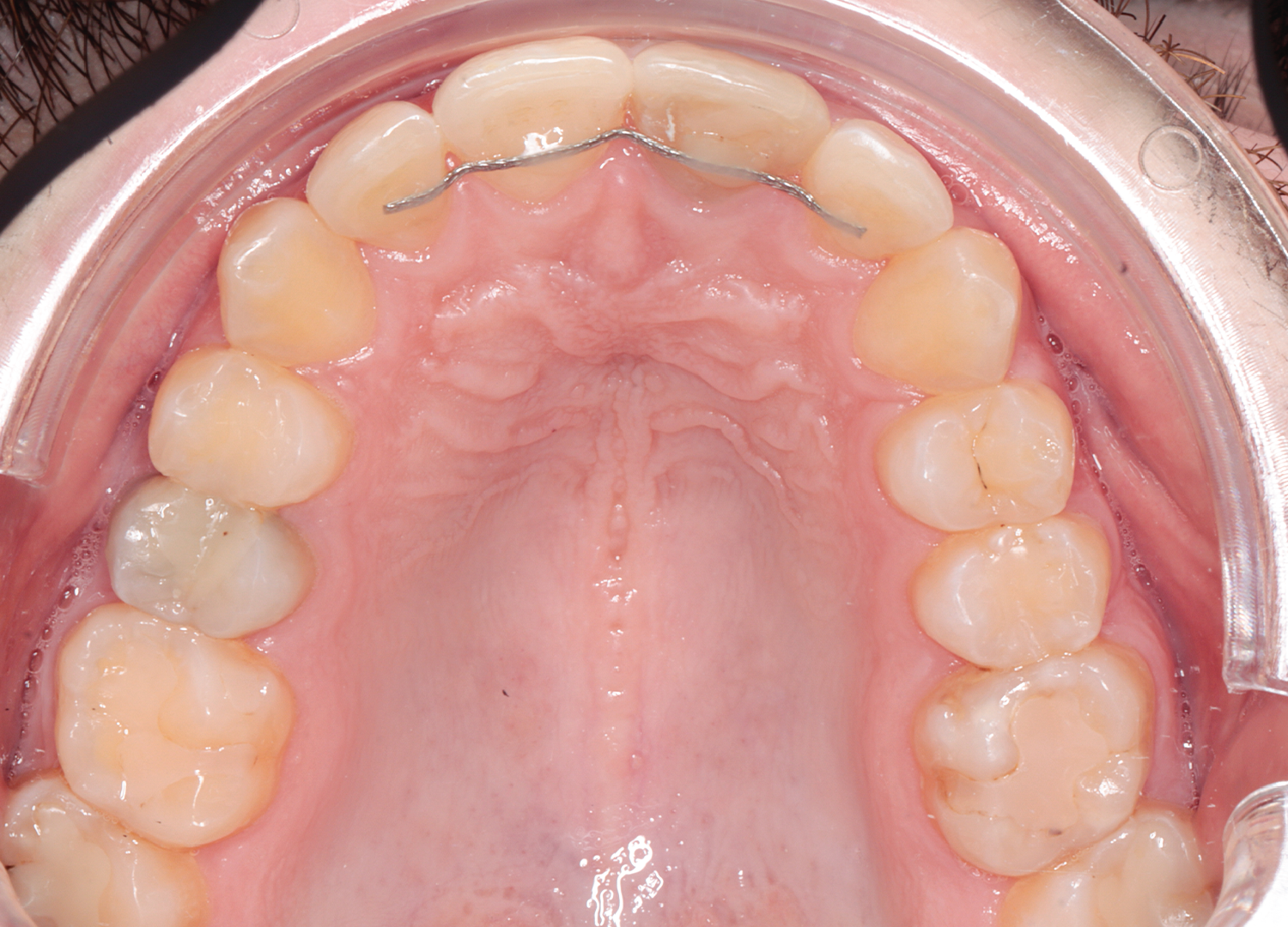 Vedere ocluzala maxilar cu retainer fix din sarma colata pentru stabilitate post-tratament Orto Clinic Tas Razvan