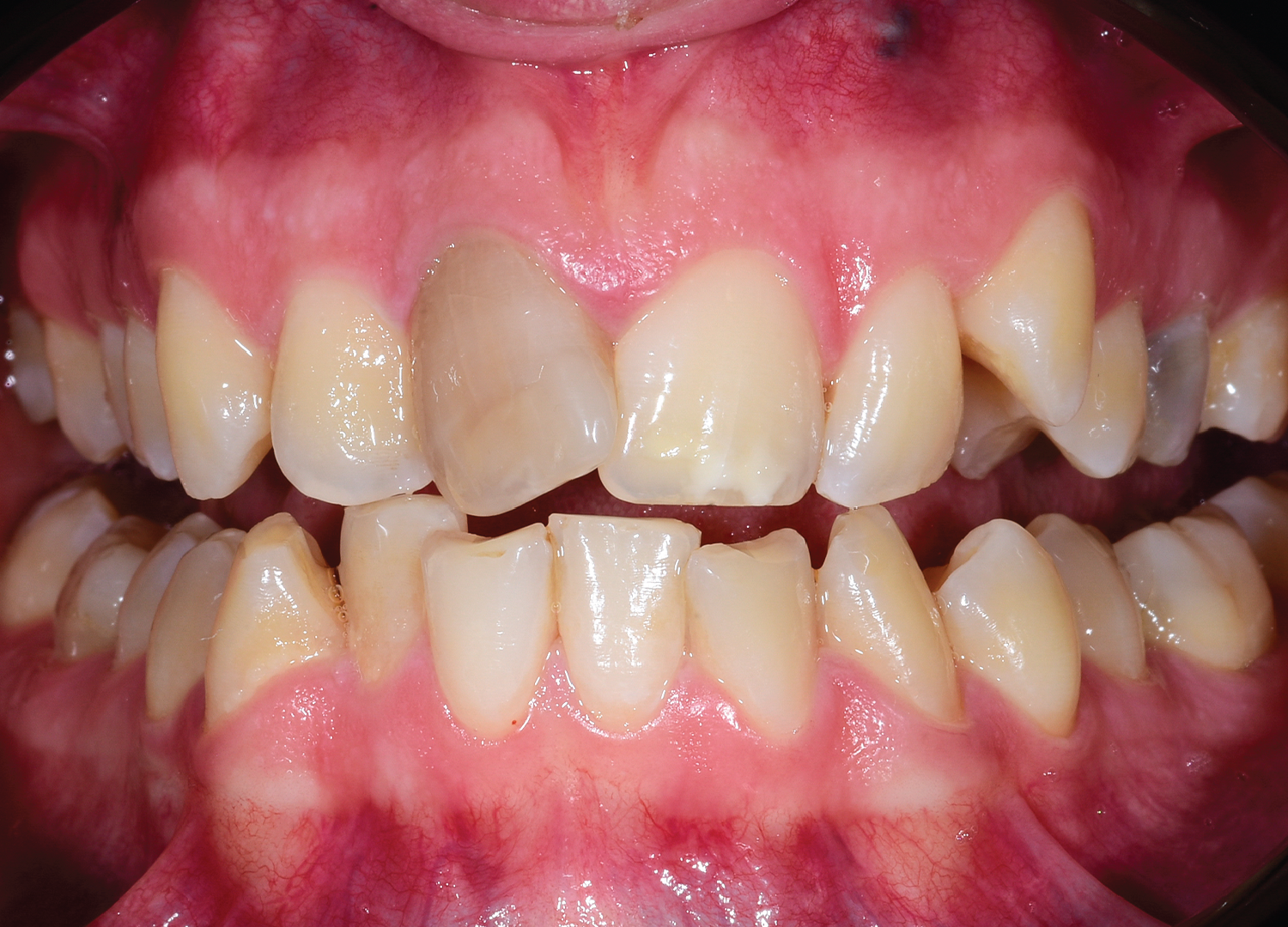 Diagnostic initial inghesuire dentara severa si dinte devital cu discromie inainte de tratament Orto Clinic Tas Razvan