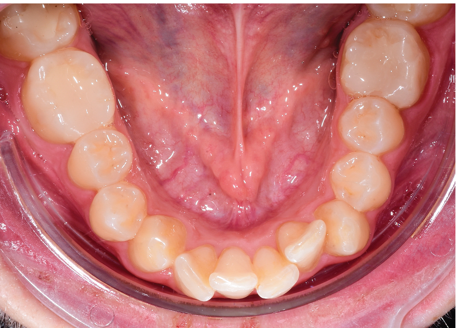 Vedere ocluzala mandibula cu dinti inghesuiti si rotatii dentare diagnostic Orto Clinic Tas Razvan