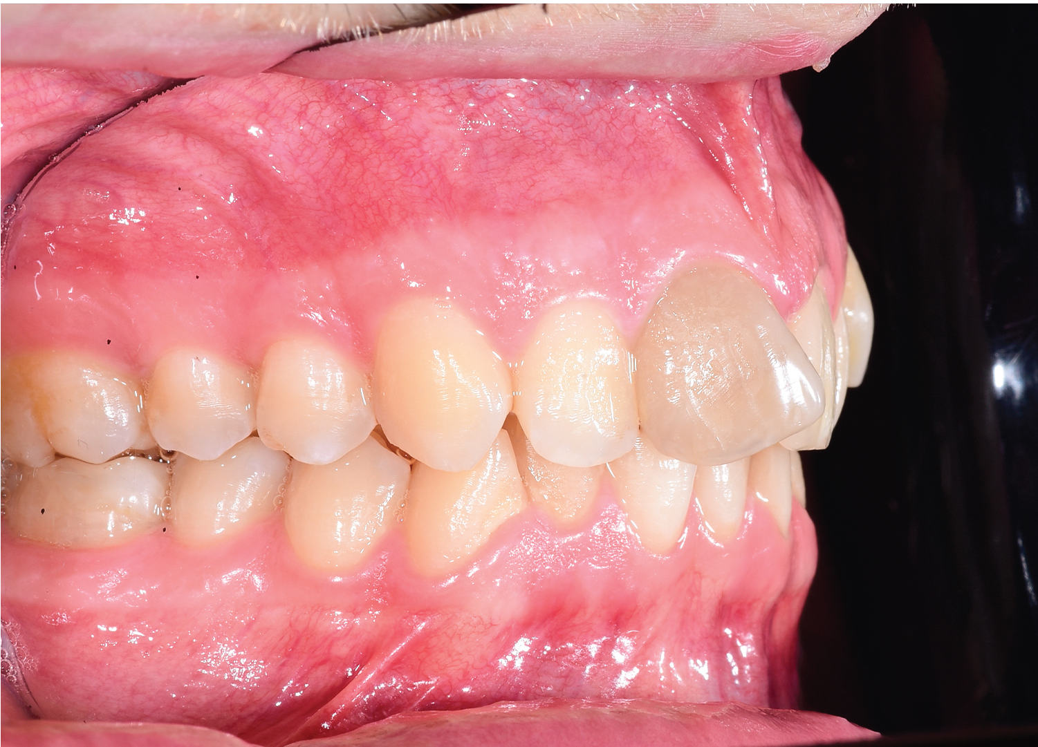 Vedere laterala ocluzie dentara si evaluare estetica profil pacient adult Orto Clinic Tas Razvan