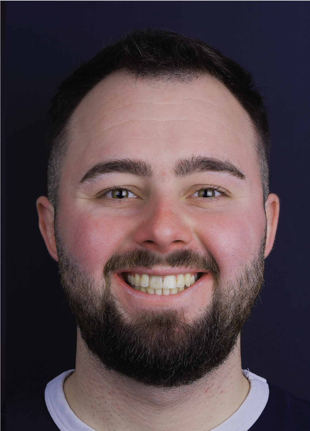 Portret pacient barbat inainte de aparat dentar - consultatie initiala Orto Clinic Tas Razvan